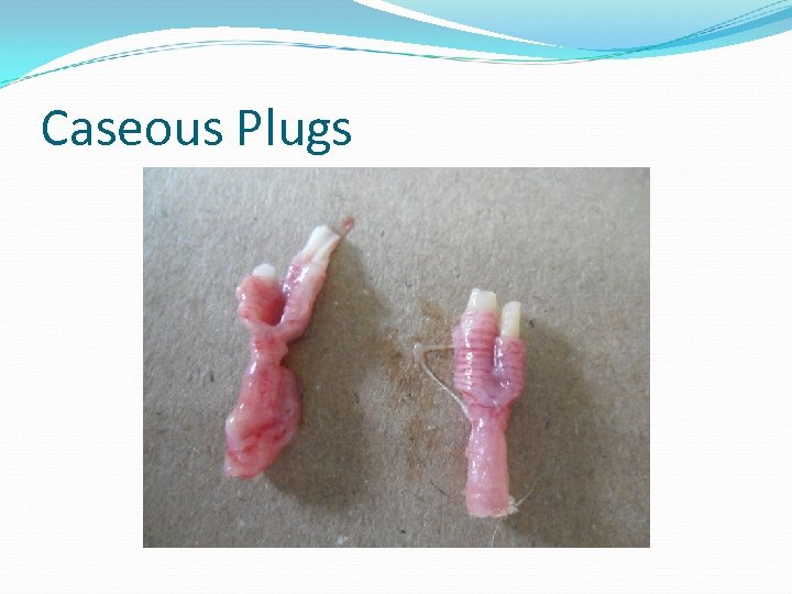 Caseous Plugs 