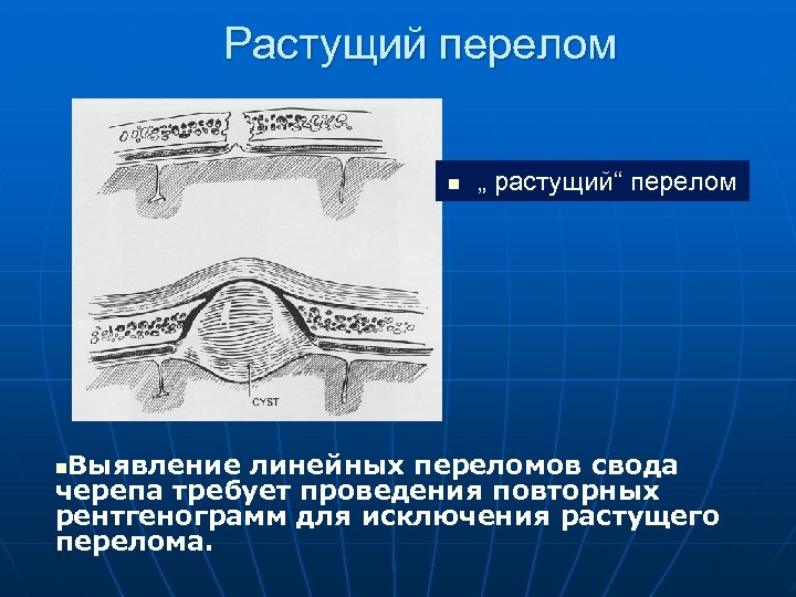 Линейная трещина. Растущий перелом черепа. Линейный перелом черепа.