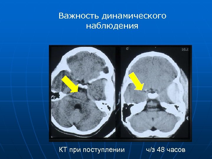 Важность динамического наблюдения КТ при поступлении ч/з 48 часов 