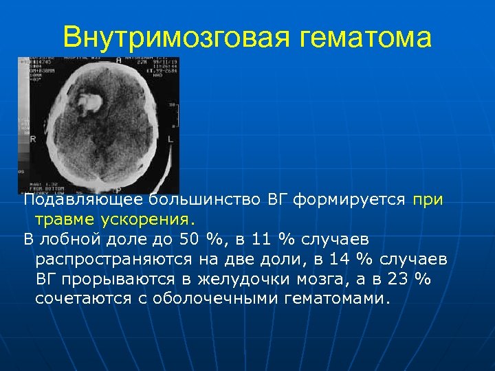 Внутримозговая гематома Подавляющее большинство ВГ формируется при травме ускорения. В лобной доле до 50