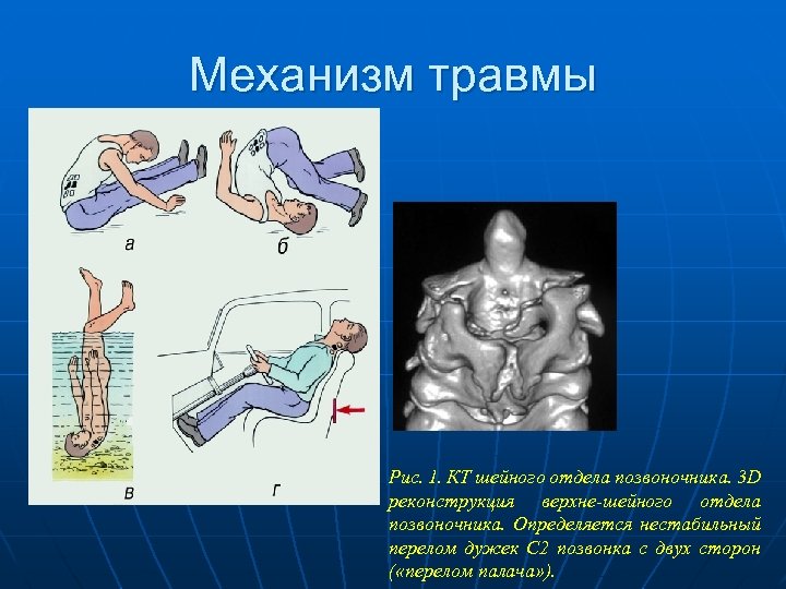 Механизм повреждения. Механизмы травмы позвоночника. Сгибательный механизм повреждения позвоночника. Перелом позвоночника механизм повреждения. Непрямой механизм травмы.