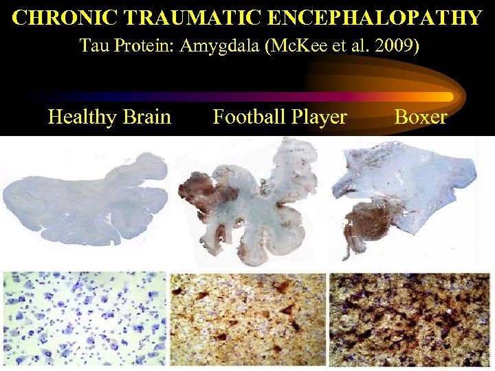 CHRONIC TRAUMATIC ENCEPHALOPATHY Tau Protein: Amygdala (Mc. Kee et al. 2009) Healthy Brain Football