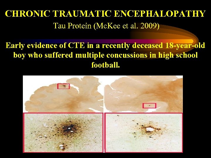 CHRONIC TRAUMATIC ENCEPHALOPATHY Tau Protein (Mc. Kee et al. 2009) Early evidence of CTE