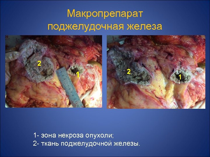 Макропрепарат поджелудочная железа 2 1 - зона некроза опухоли; 2 - ткань поджелудочной железы.