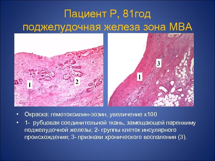 Пациент Р, 81 год поджелудочная железа зона МВА • Окраска: гемотоксилин-эозин, увеличение х100 •