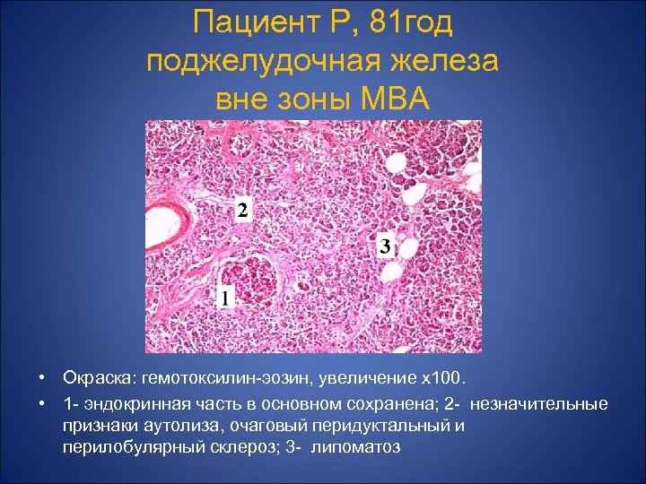 Пациент Р, 81 год поджелудочная железа вне зоны МВА • Окраска: гемотоксилин-эозин, увеличение х100.