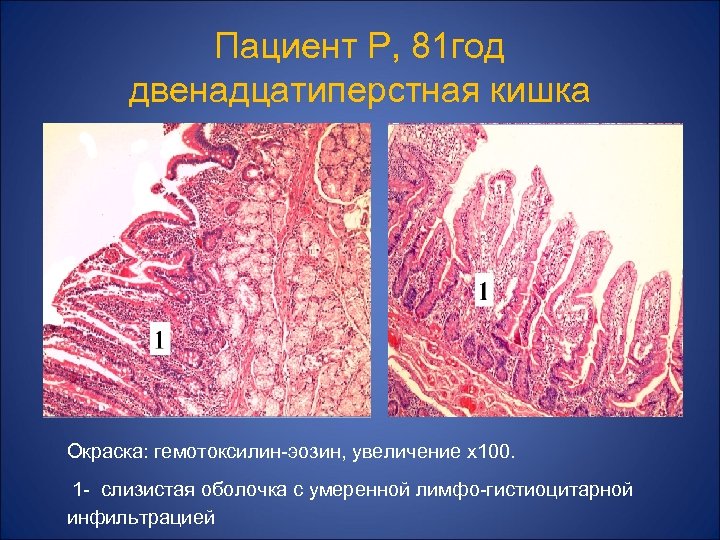 Пациент Р, 81 год двенадцатиперстная кишка Окраска: гемотоксилин-эозин, увеличение х100. 1 - слизистая оболочка