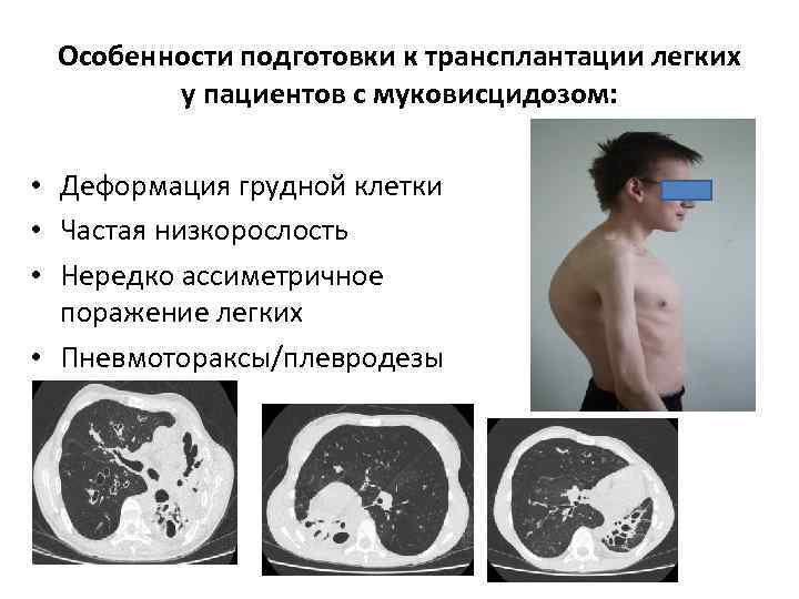 Особенности подготовки к трансплантации легких у пациентов с муковисцидозом: • Деформация грудной клетки •