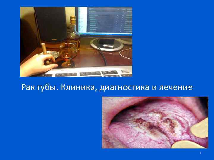 Рак губы. Клиника, диагностика и лечение 1 