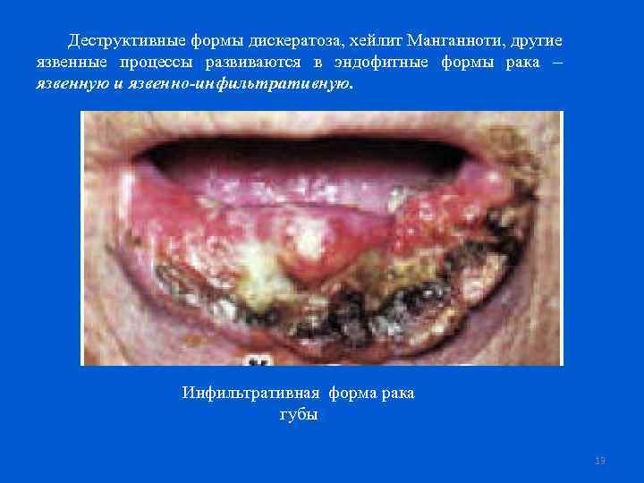 Деструктивные формы дискератоза, хейлит Манганноти, другие язвенные процессы развиваются в эндофитные формы рака –