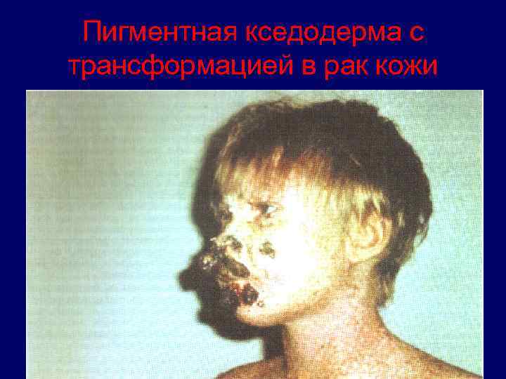 Пигментная кседодерма с трансформацией в рак кожи 