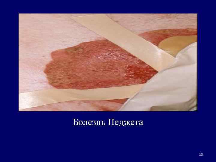 Болезнь Педжета 25 