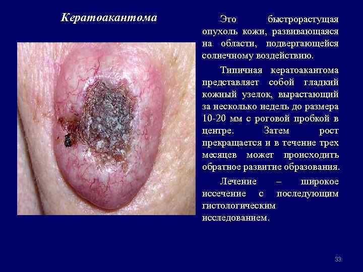 Кератоакантома Это быстрорастущая опухоль кожи, развивающаяся на области, подвергающейся солнечному воздействию. Типичная кератоакантома представляет