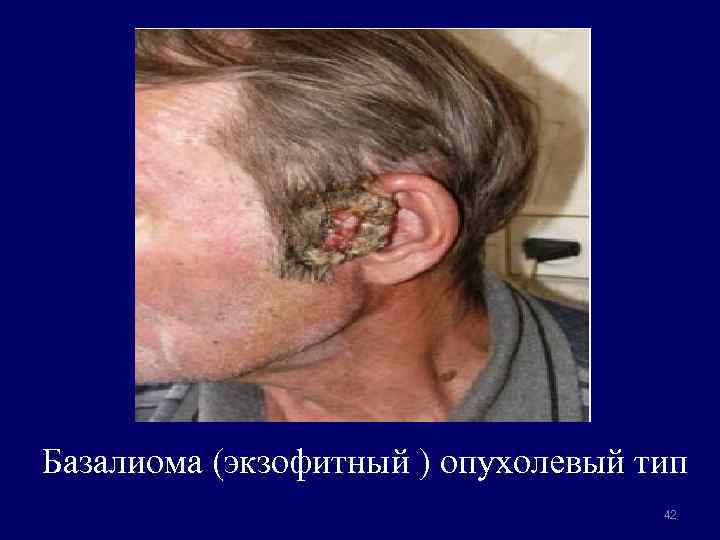Базалиома (экзофитный ) опухолевый тип 42 