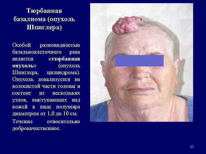 Тюрбанная базалиома (опухоль Шпиглера) Особой разновидностью базальноклеточного рака является «тюрбанная опухоль» (опухоль Шпиглера, цилиндрома).