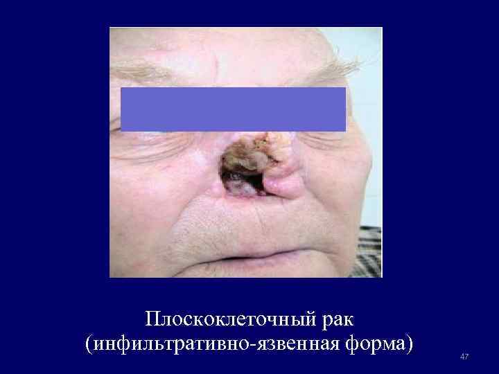 Плоскоклеточный рак (инфильтративно-язвенная форма) 47 