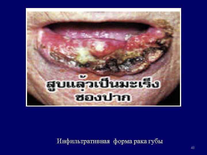Инфильтративная форма рака губы 48 