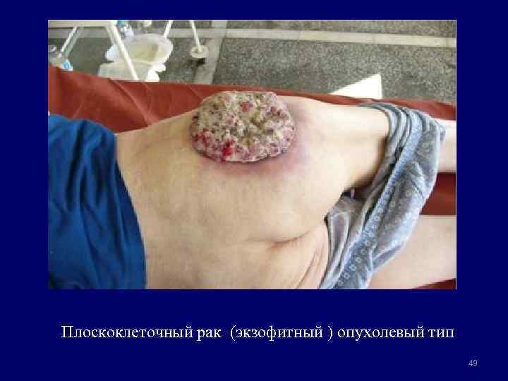 Плоскоклеточный рак (экзофитный ) опухолевый тип 49 