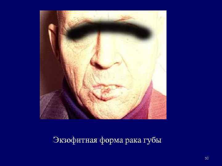 Экзофитная форма рака губы 50 