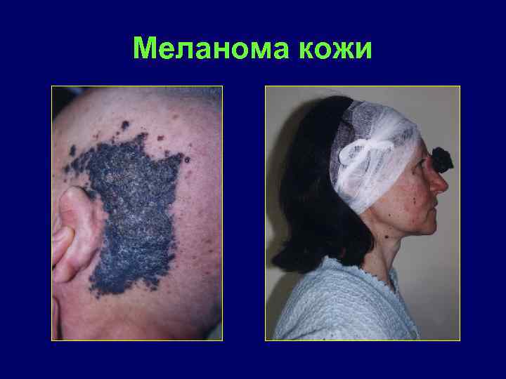 Меланома кожи 