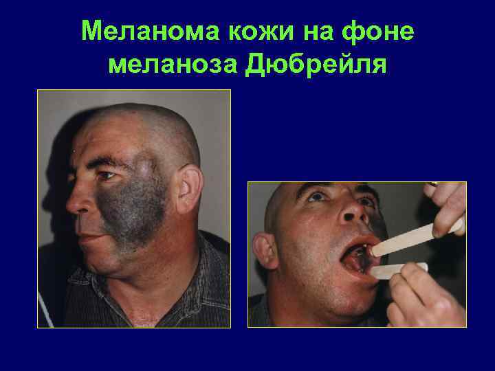 Меланома кожи на фоне меланоза Дюбрейля 