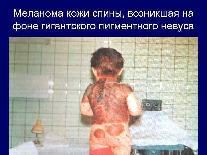 Меланома кожи спины, возникшая на фоне гигантского пигментного невуса 