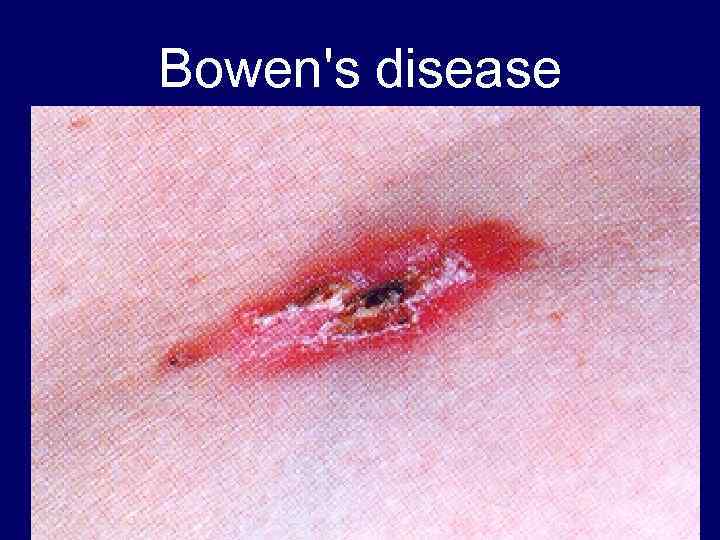 Bowen's disease 