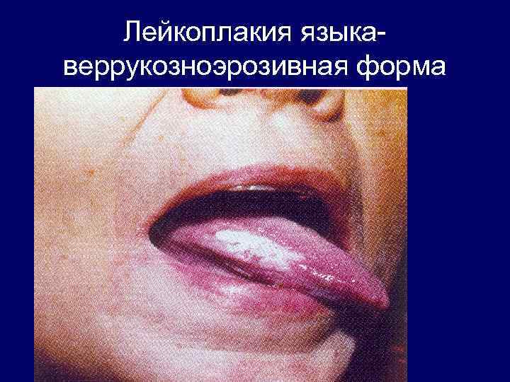 Лейкоплакия языкаверрукозноэрозивная форма 