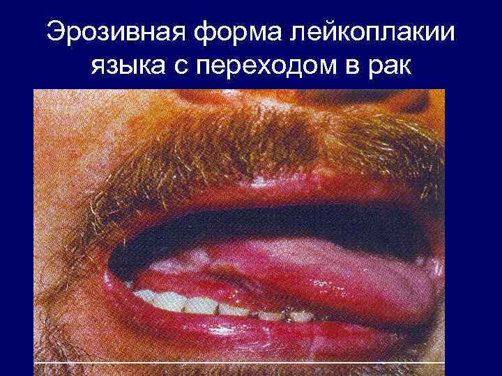 Эрозивная форма лейкоплакии языка с переходом в рак 