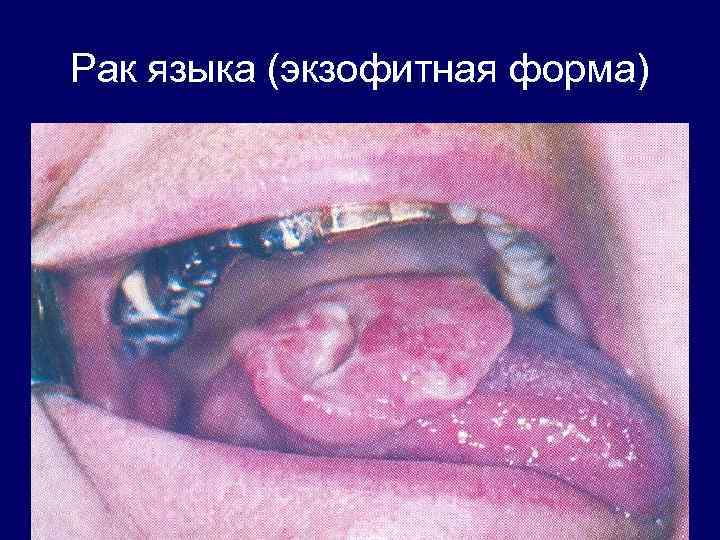 Рак языка (экзофитная форма) 