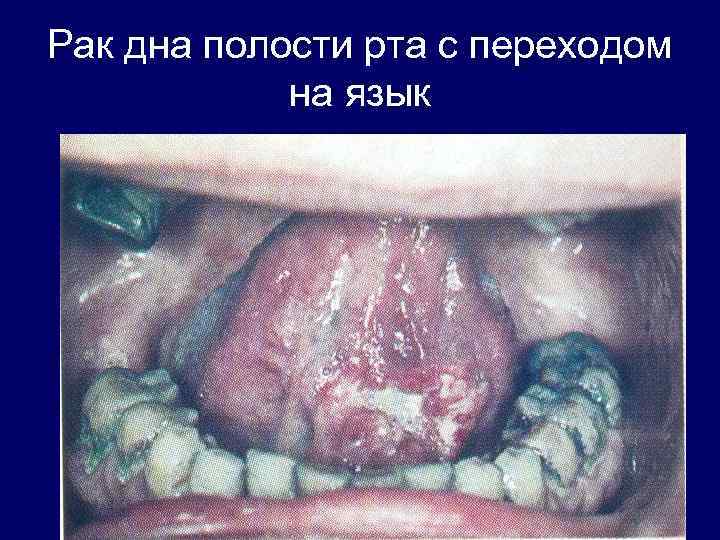 Рак дна полости рта с переходом на язык 