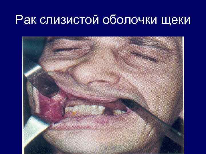 Рак слизистой оболочки щеки 