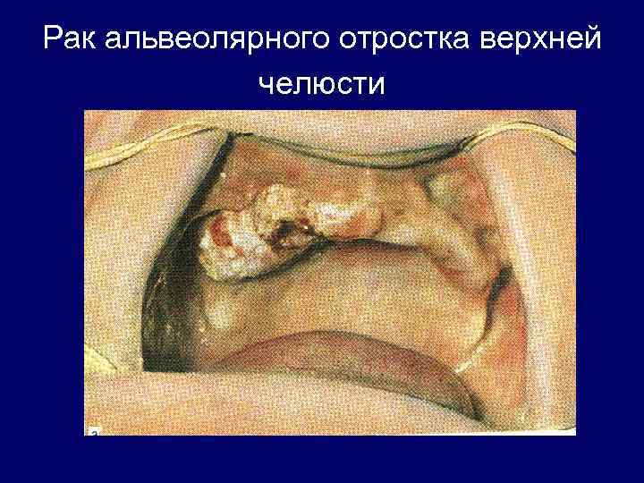 Рак альвеолярного отростка верхней челюсти 