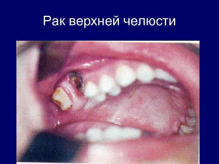 Рак верхней челюсти 