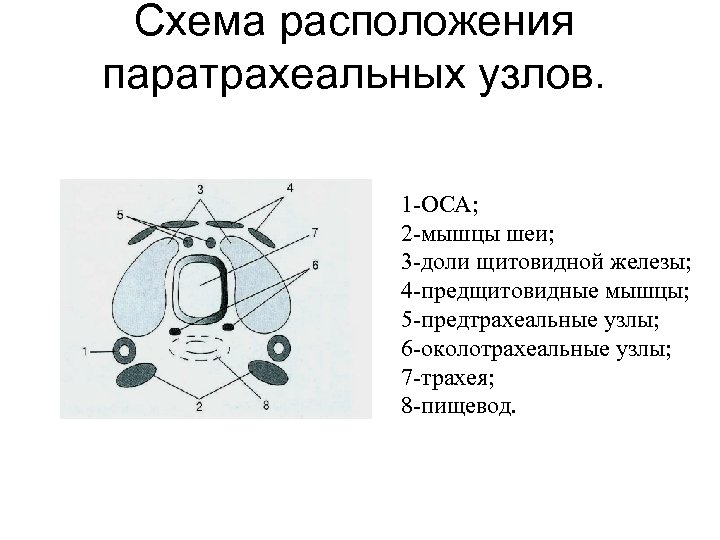 Схема расположения паратрахеальных узлов. 1 -ОСА; 2 -мышцы шеи; 3 -доли щитовидной железы; 4
