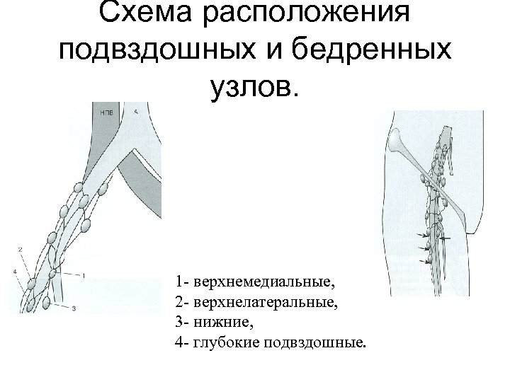 Схема расположения подвздошных и бедренных узлов. 1 - верхнемедиальные, 2 - верхнелатеральные, 3 -