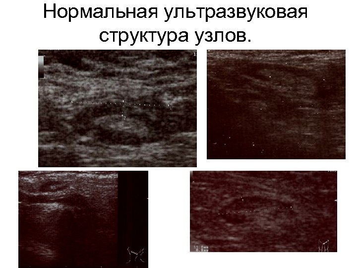 Нормальная ультразвуковая структура узлов. 