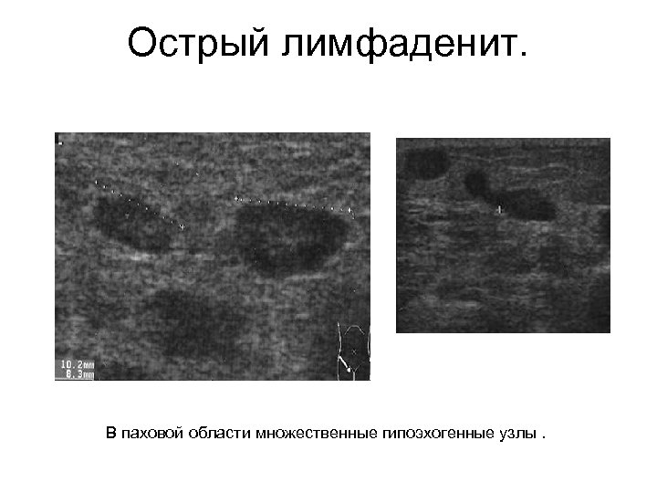 Острый лимфаденит. В паховой области множественные гипоэхогенные узлы. 
