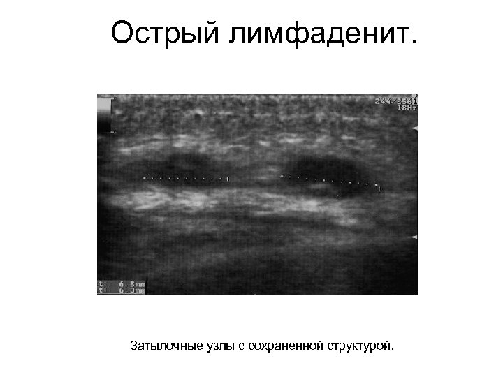 Острый лимфаденит. Затылочные узлы с сохраненной структурой. 