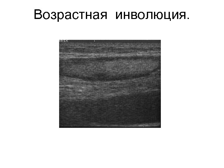 Возрастная инволюция. 