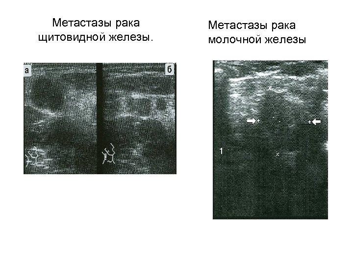 Метастазы рака щитовидной железы. Метастазы рака молочной железы 