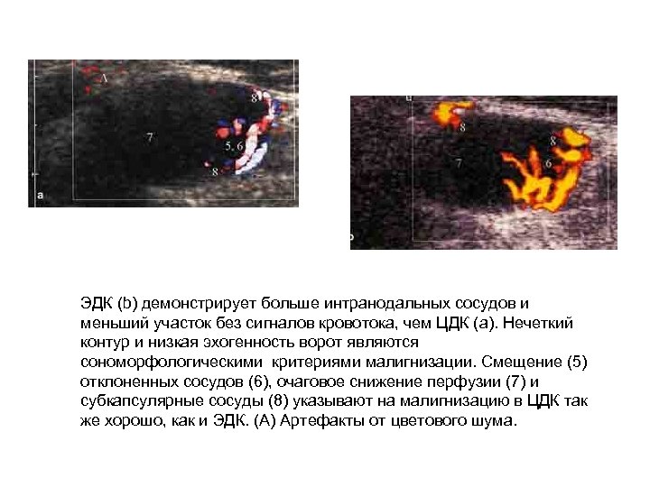 ЭДК (b) демонстрирует больше интранодальных сосудов и меньший участок без сигналов кровотока, чем ЦДК