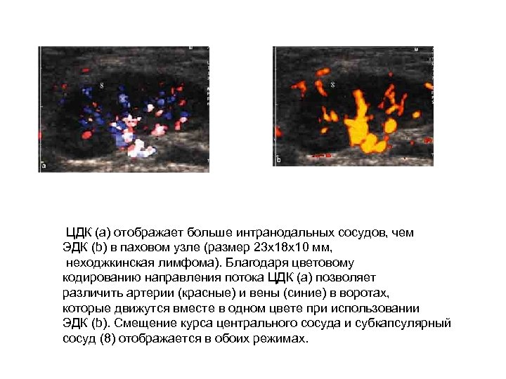 ЦДК (a) отображает больше интранодальных сосудов, чем ЭДК (b) в паховом узле (размер 23