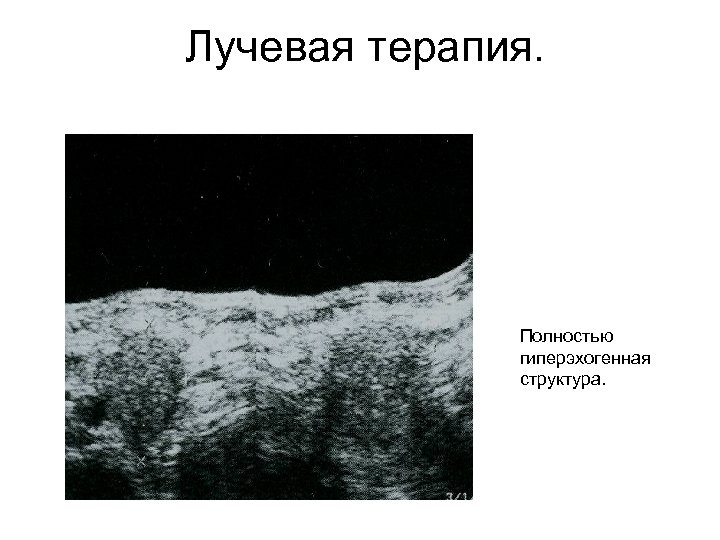 Лучевая терапия. Полностью гиперэхогенная структура. 