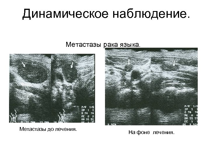 Динамическое наблюдение. Метастазы рака языка. Метастазы до лечения. На фоне лечения. 