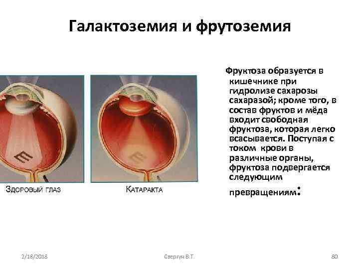 Галактоземия и фрутоземия Фруктоза образуется в кишечнике при гидролизе сахарозы сахаразой; кроме того, в