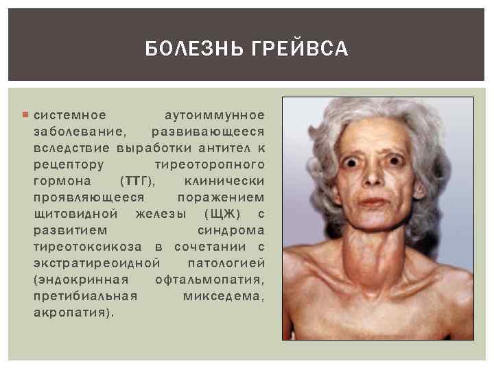 БОЛЕЗНЬ ГРЕЙВСА системное аутоиммунное заболевание, развивающееся вследствие выработки антител к рецептору тиреоторопного гормона (ТТГ),