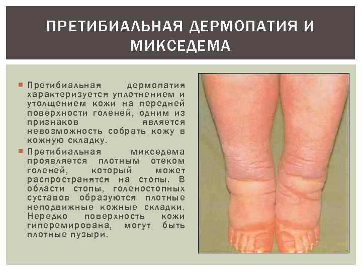 ПРЕТИБИАЛЬНАЯ ДЕРМОПАТИЯ И МИКСЕДЕМА Претибиальная дермопатия характеризуется уплотнением и утолщением кожи на передней поверхности