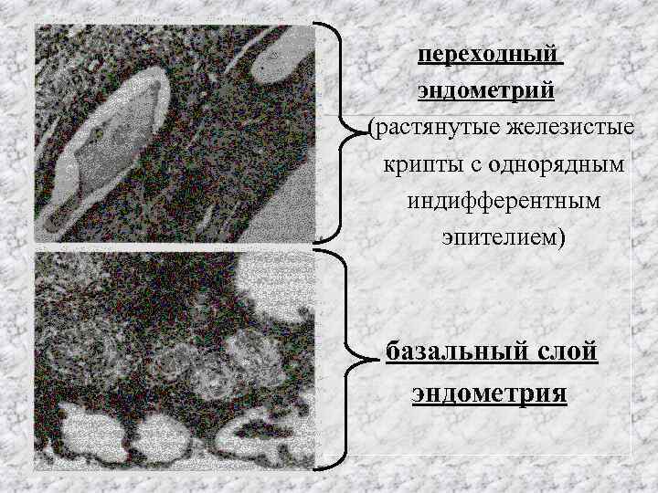 переходный эндометрий (растянутые железистые крипты с однорядным индифферентным эпителием) базальный слой эндометрия 