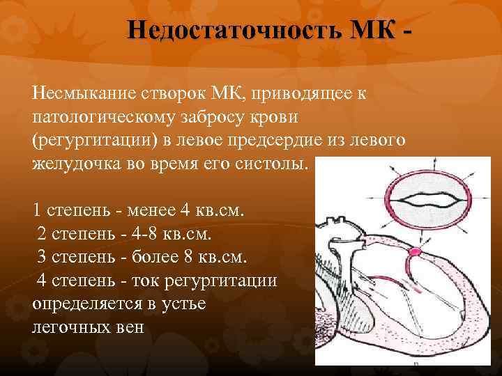 Недостаточность МК Несмыкание створок МК, приводящее к патологическому забросу крови (регургитации) в левое предсердие